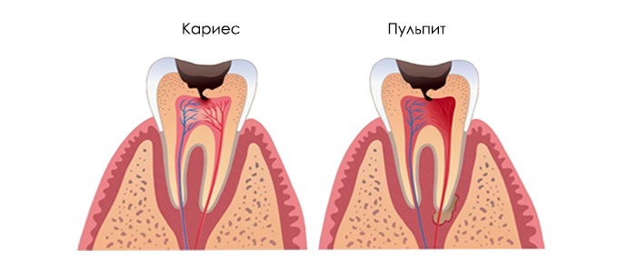 Лечение пульпита зубов у детей