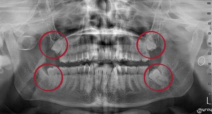 Видалення зуба мудрості