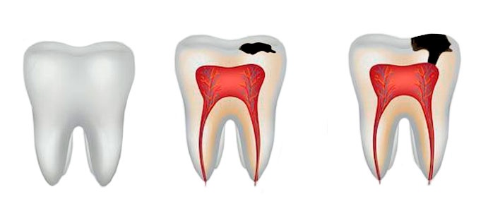 Лікування гіпоплазії зубів у дітей