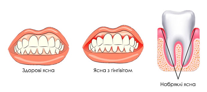 Лікування гінгівіту у дітей