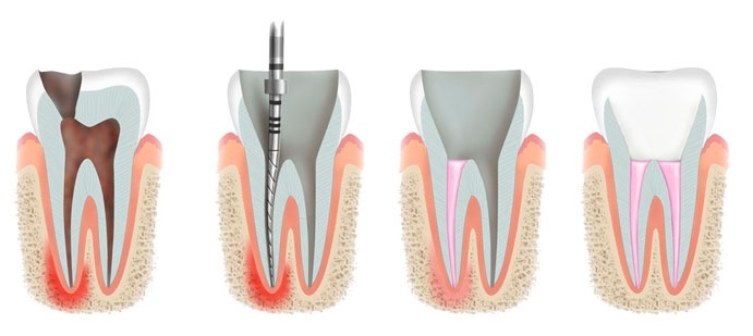 Лечение каналов зуба у детей