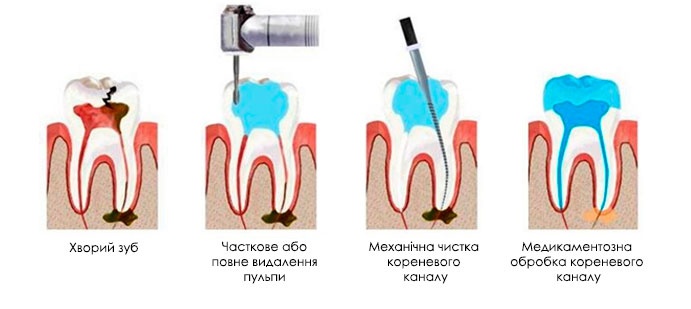 Лікування каналів зуба у дітей